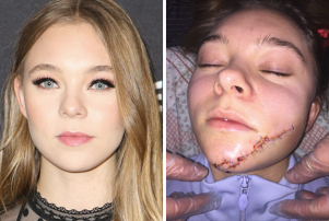 taylor-hickson-injury-before-after-scar.jpg